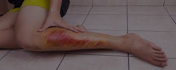 Leg Injury Claim